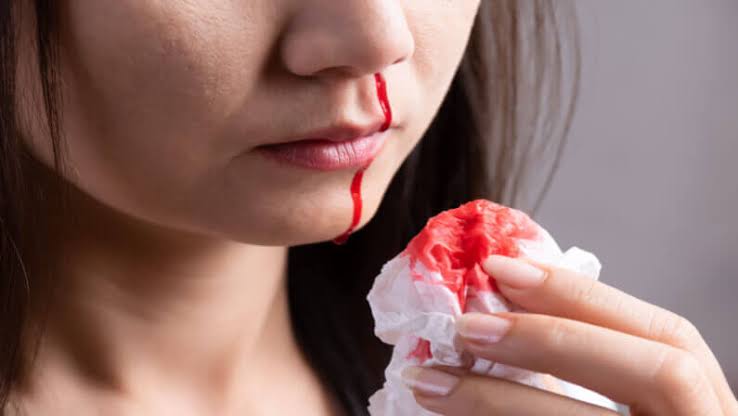 What is the most common cause of epistaxis❓

A. Hypertension
B. Trauma 
C. Sinusitis 
D. Nasal tumor