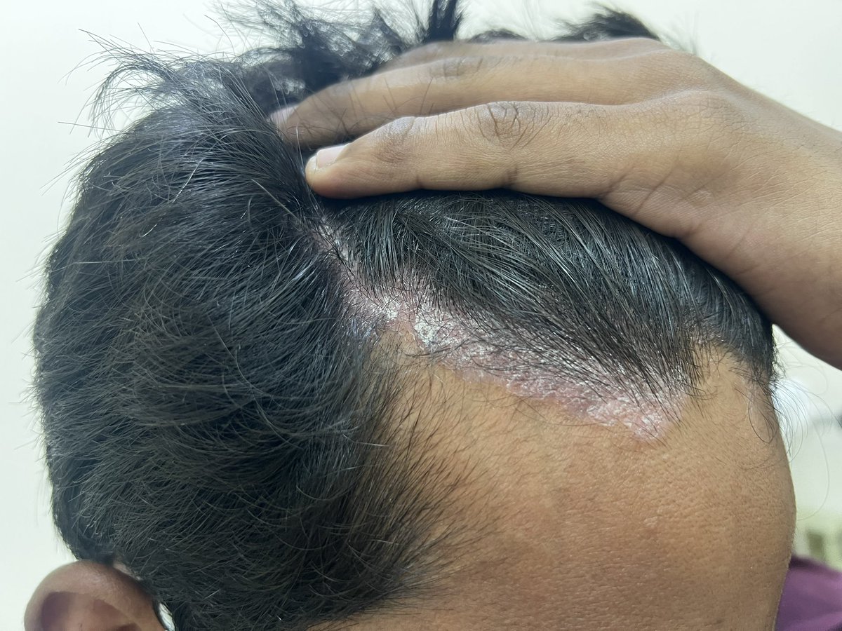 IlliasulK's tweet image. A young adult presents with:

• Morning stiffness in the back

• Heel pain

• Chronic recurrent scalp rash

What unifying diagnosis ties spine, skin, and enthesis together? 🧩

#RheumTwitter #DermTwitter #MedTwitter #Rheumatology #Immunology 
#Sullysrounds #MedX #Medtwitter