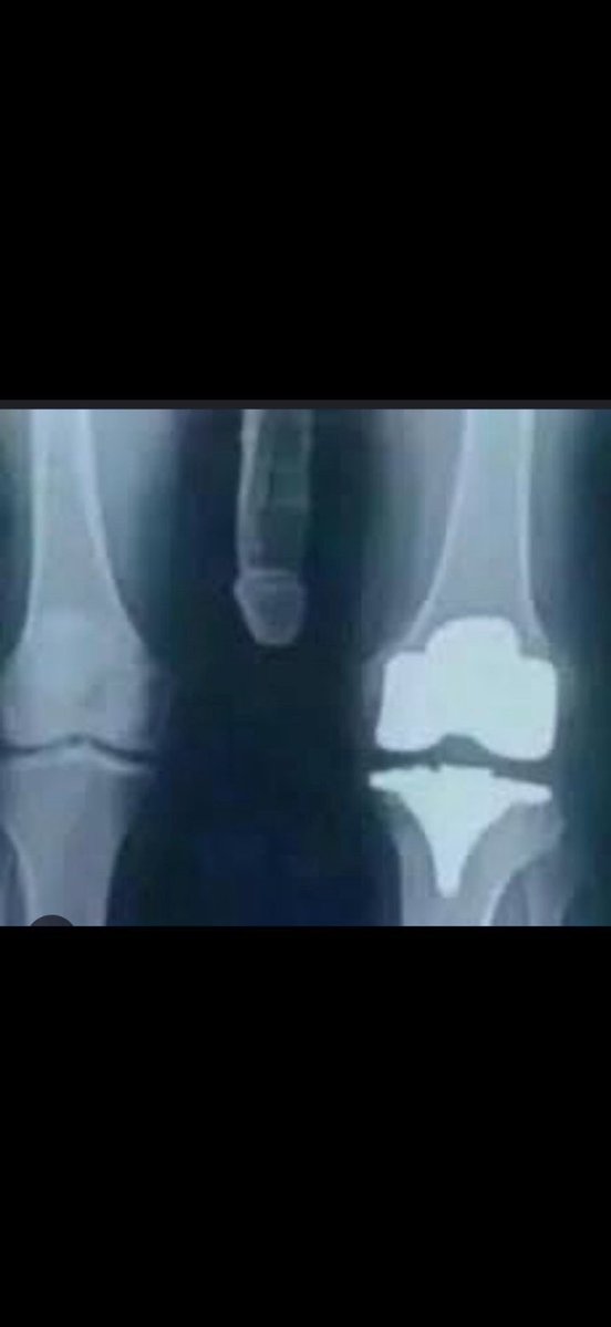 Just tore my ACL in my men’s league game 

Pray for me 🙏