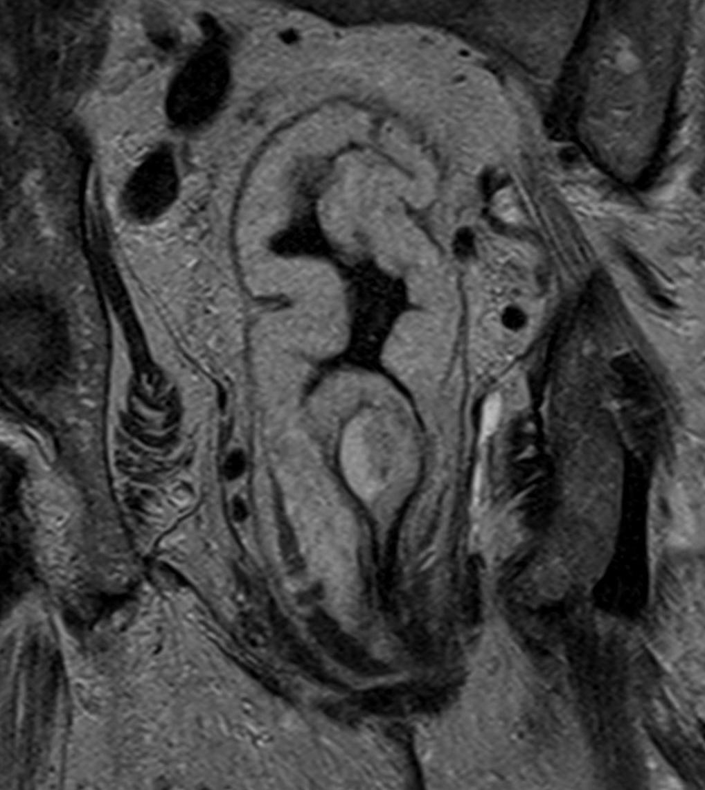 74-year-old female patient presenting with melena... can you guess this rare diagnosis? 

<a href="/BrighamRad/">Brigham and Women's Radiology</a> <a href="/FOAMrad/">FOAMrad</a> <a href="/SAR_RFS/">SAR Resident and Fellow Section</a> <a href="/futureradres/">Future Radiology Residents</a> <a href="/ARRS_Radiology/">ARRS</a> <a href="/Abdominal_Rad/">Abdominal Radiology</a> <a href="/CBRadiologia/">CBR</a> #MedEd