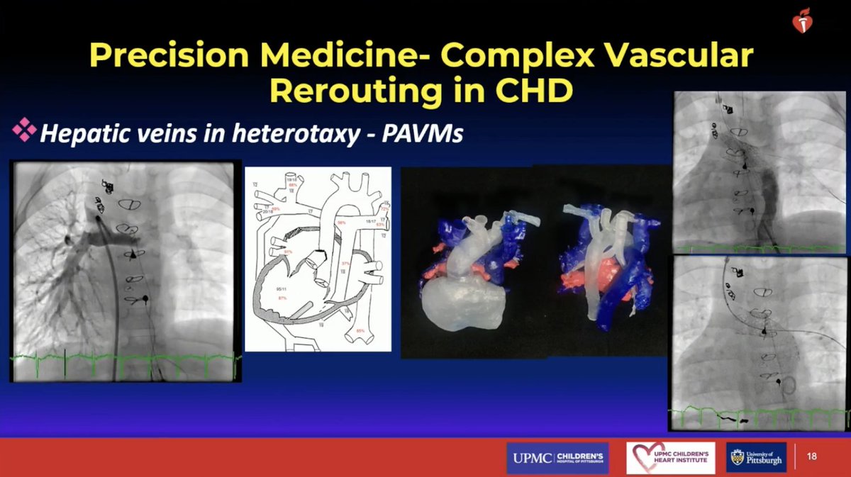 Dr. Jacqueline Kreutzer shares examples of  personalized transcatheter interventions for #CHD already being practiced today: transcatheter pulmonary valve replacement, superior sinus venosus defect repair, edge-to-edge valve repair, and rerouting hepatic veins. #AHA25/#ReSS25
