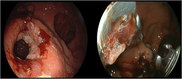GIE_Journal's tweet image. Boortalary et al exhibit &quot;Success of different closure modalities of gastrogastric or jejunal-gastric fistulas after EUS-directed transgastric intervention.&quot; giejournal.org/article/S0016-… 

#GITwitter 

@mkahaleh @amytyberg @RishiPawa @EthanCohenMed @shailsingh @reemsharaiha