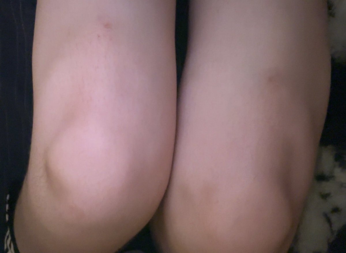 mileslovesyouu's tweet photo. leg bruises :-( https://t.co/mlsRO9HkEJ