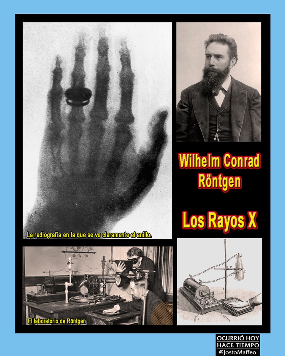🩻 LOS RAYOS X 

8 Noviembre 1895.  En la primera #radiografía se aprecia una mano con un anillo en el anular. Son los #RayosX.
El descubridor es el alemán Wilhelm Conrad #Röntgen. En 1901 le valdrá el primer #Nobel por la #física. 
 Röntgen renunciará a lucrarse con la patente.