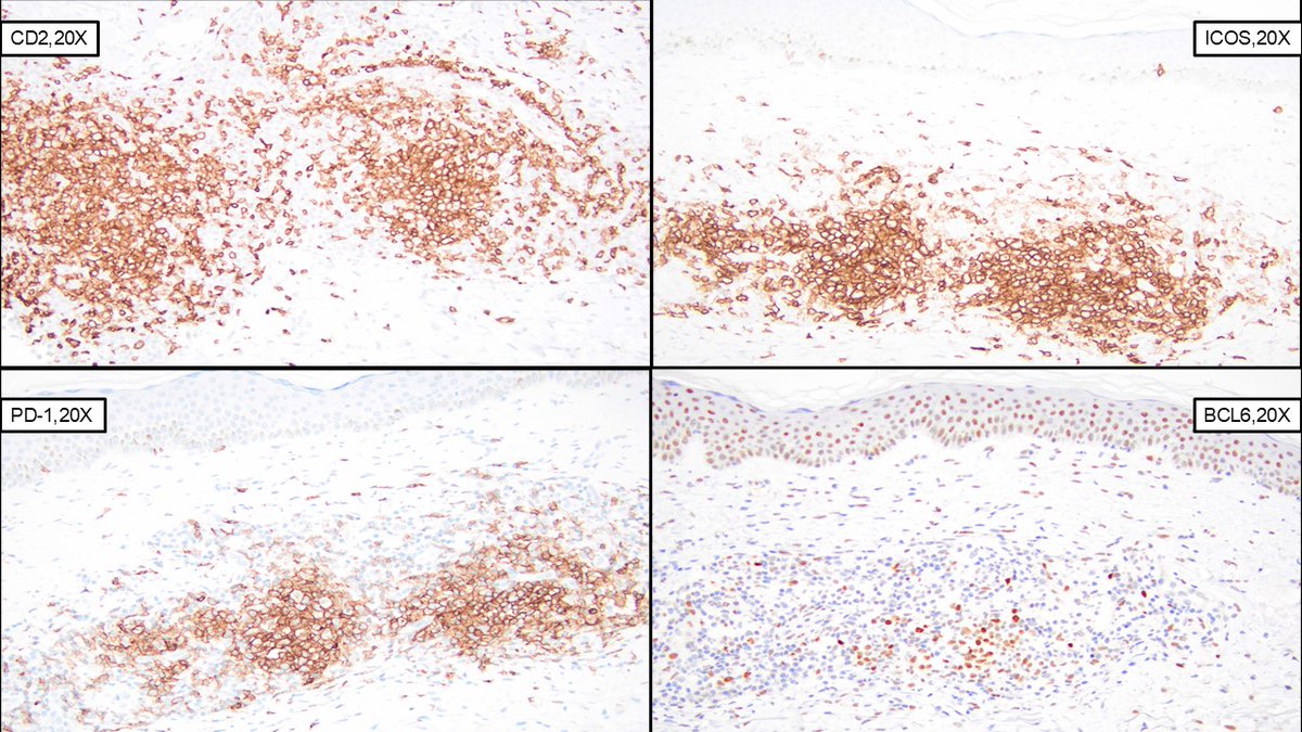 For anyone attending #ASDP25, please check out <a href="/AlhalasehY/">Yazan Alhalaseh</a>'s talk happening soon as part of Oral Abstract Session 1 in Key Ballroom 1-6!  Feel free to sneak in the back or sit right up front.  He will be presenting a fascinating case of TFH lymphoma primarily involving the skin.