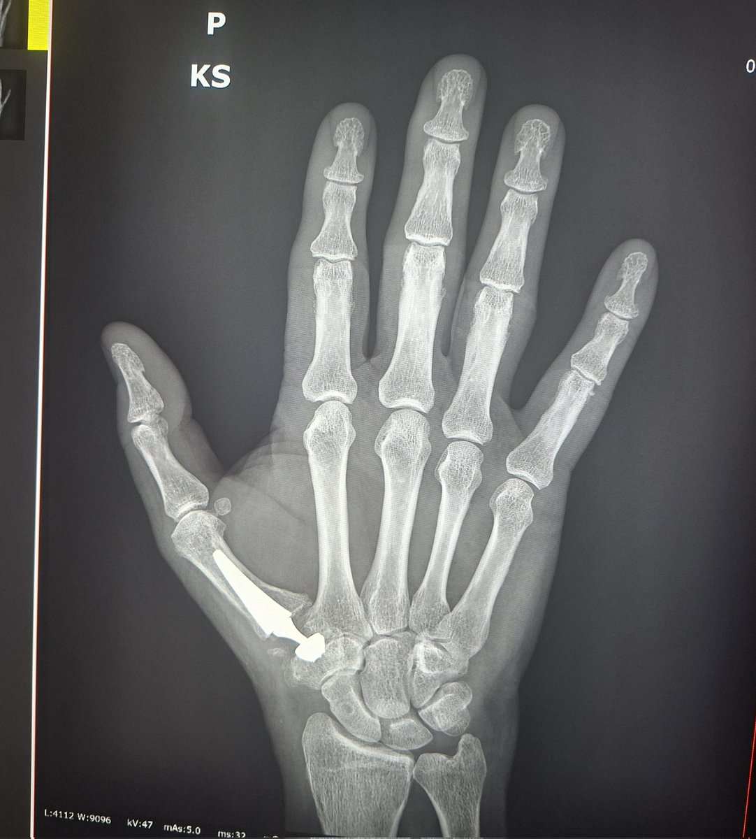 Каждый день на работе приносит что-то необычное. Такого протеза я ещё не видела:)