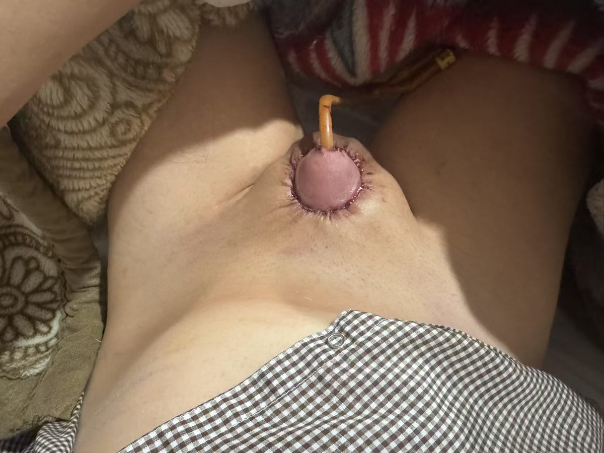 阴茎缩短术Penile skin castration tweet media