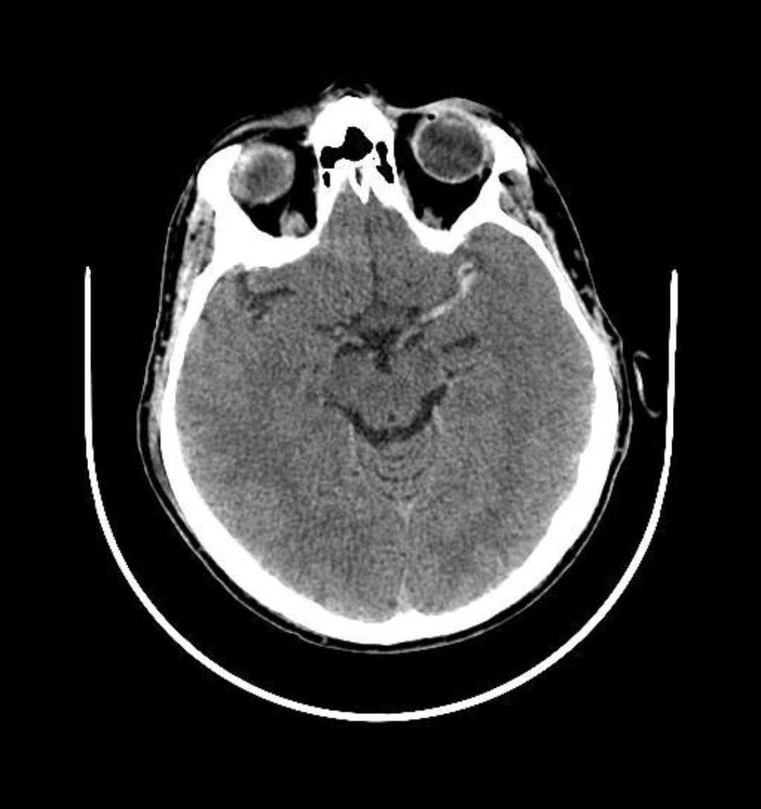DocChukx's tweet image. Friday #neuro #stroke teaser

Patient below, 62 years, stage IV pancreatic CA in Hospice care. Presents within the window for lytics and MT. NIHSS 17 mostly aphasia and hemiplegia. Frail requiring help for all ADL

What are your next steps?

Image: radiopaedia.