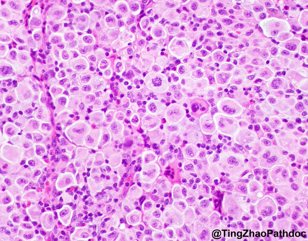 TingZhaoPathdoc's tweet photo. 60s M, bladder transurethral resection. What is your diagnosis?
#PathTwitter
@MGBpathology @MGHPathology https://t.co/aJuplMiPsj