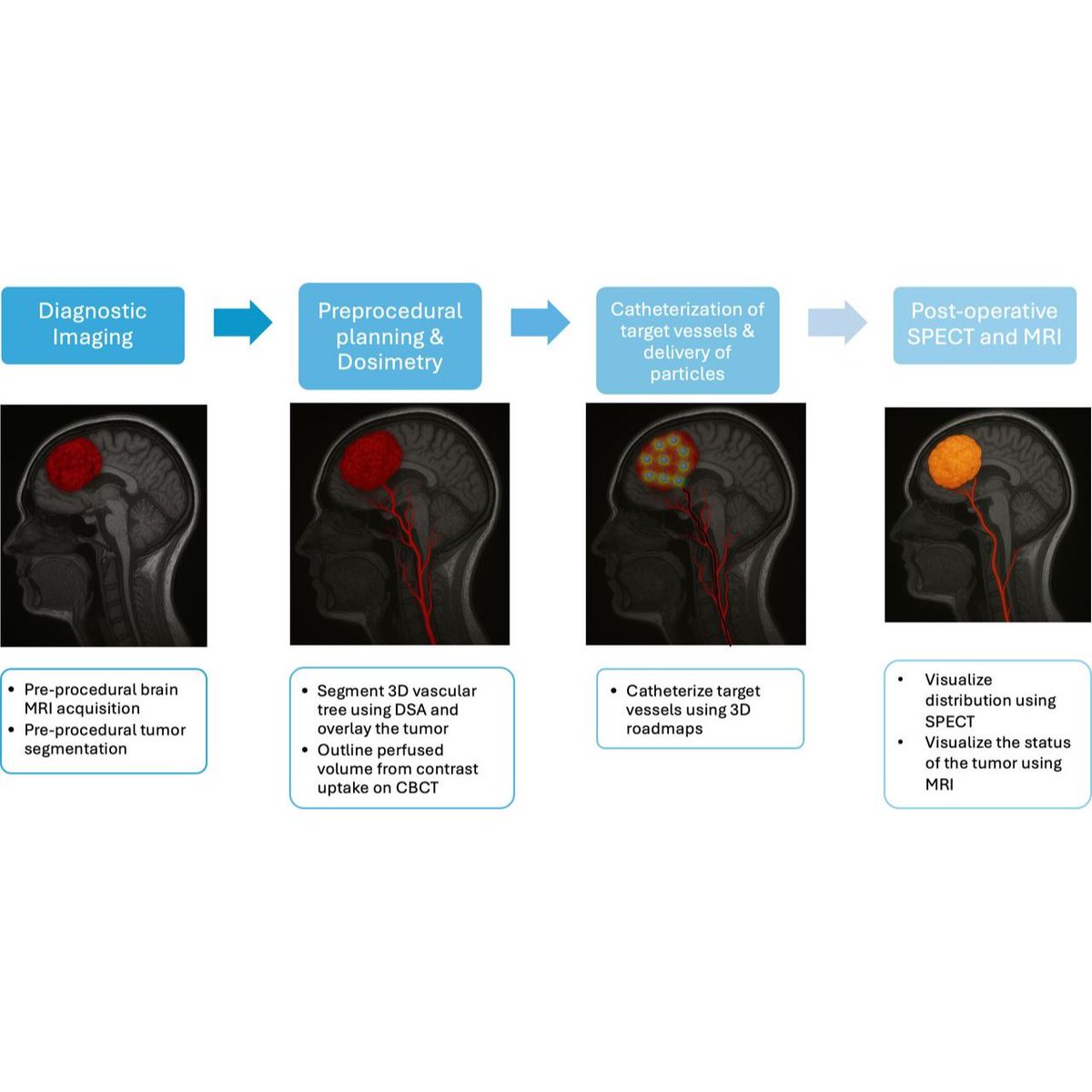 JNIS_BMJ's tweet image. Is endovascular therapy the future of brain tumor treatment? Emerging research on Yttrium-90 endovascular radiosurgery hints at a way to target tumors from within—crossing the BBB and sparing healthy tissue. Early signs point to this being a game-changing therapy! #NeuroOncology…