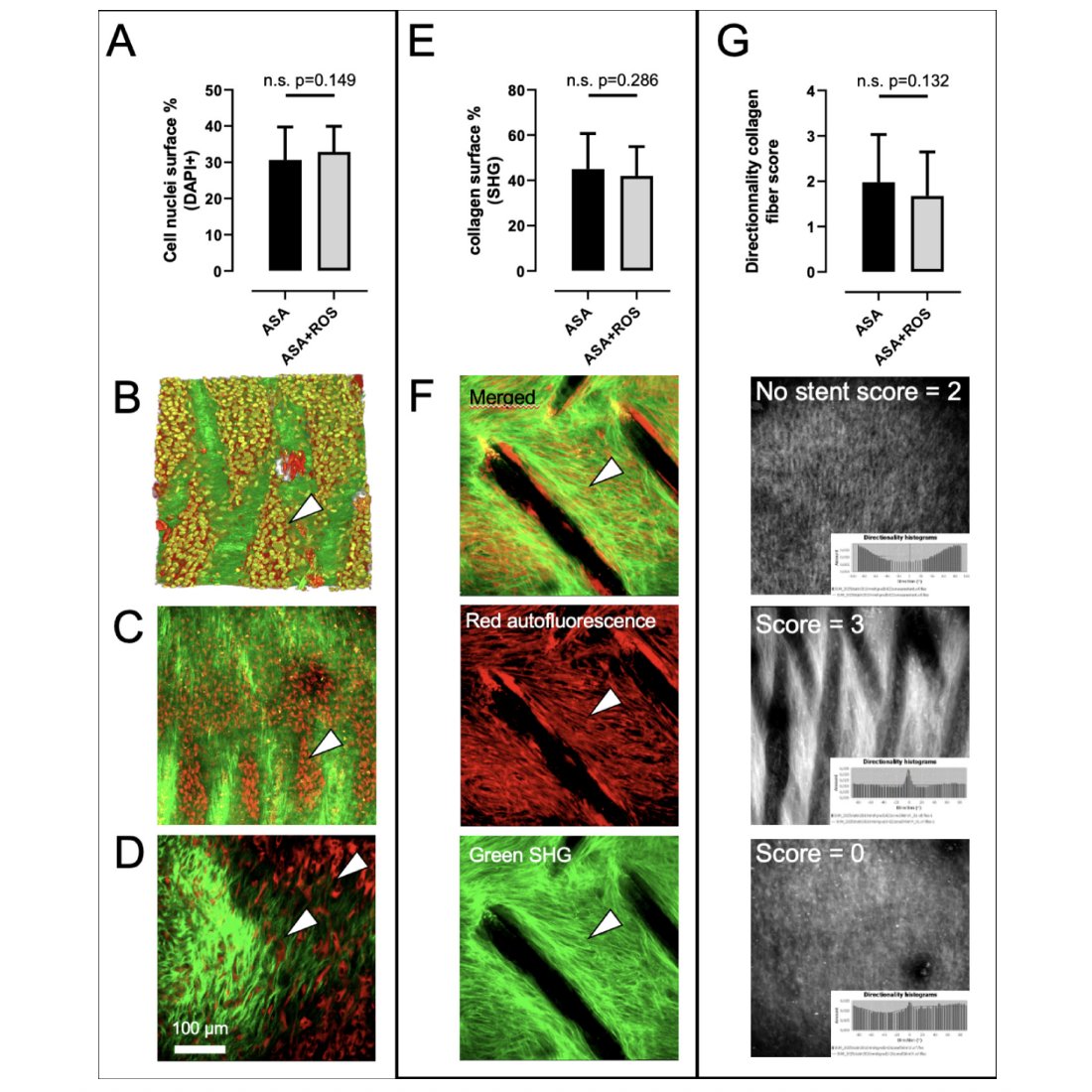 JNIS_BMJ's tweet image. Exciting breakthrough in #Neurointervention! In rabbits, rosuvastatin boosted healing after flow diverter placement—better aneurysm closure, open side branches, and stronger vessel lining. A hint at smarter stent therapy ahead. @fdianamd #NeuroIntervention #flowdiversion…
