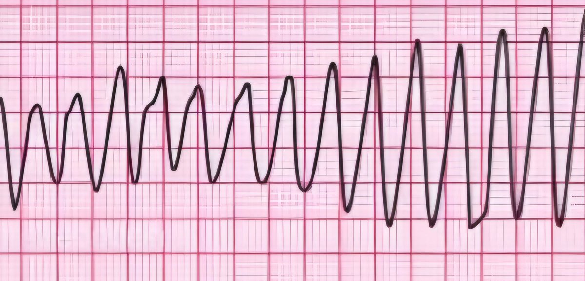 nervemed's tweet image. What is the most appropriate initial pharmacological therapy for this arrhythmia❓

A. Amiodarone
B. Procainamide
C. Magnesium Sulfate
D. Metoprolol