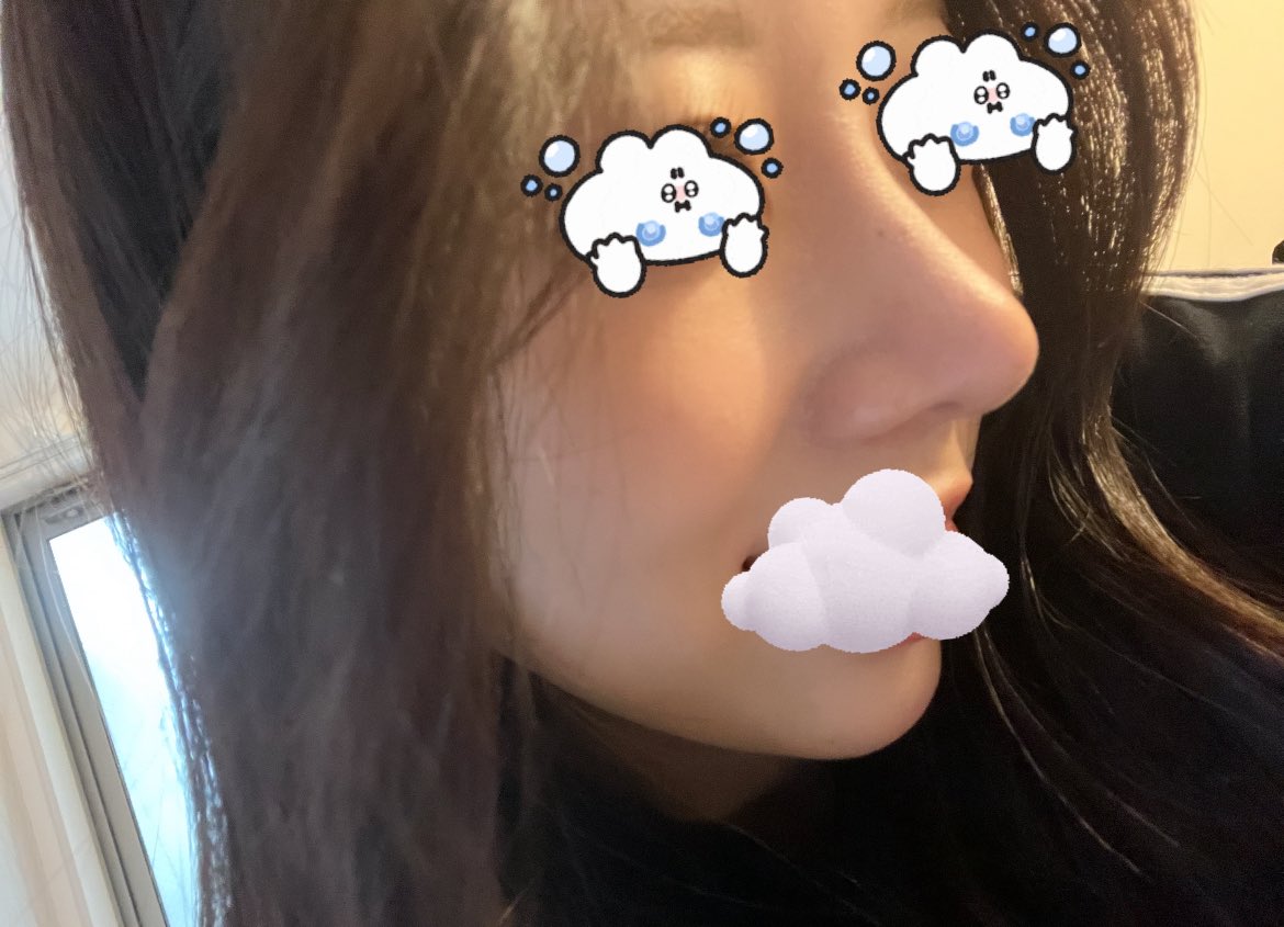 mber12's tweet photo. オペの翌日帰国した 弾丸鼻整形
３ヶ月経ったよー𐔌ᵔ ܸ>⩊<︎︎ ͡ 𐦯ᡣ𐭩

#LUHO整形外科
#ルホ整形外科 https://t.co/86K7f8FWjL