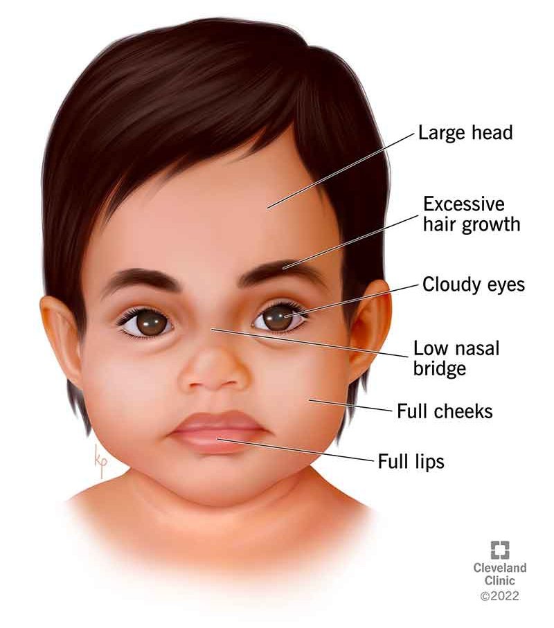 IhabFathiSulima's tweet image. #Cloudy_eyes .
What is the syndrome?
#MedTwitter