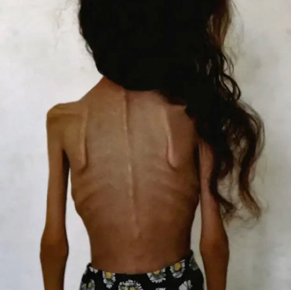 No one seems to care anymore.

My little sister and I suffer from severe anemia due to malnutrition and the lack of healthy, iron-rich food. We can’t afford it daily — it’s simply too expensive. We urgently need proper meals, meat, vitamins, and regular B12 (Tri-B) injections.