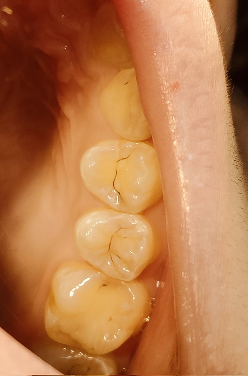 illbell8tenmus's tweet photo. ちなみにこの歯には虫歯がありますかありませんか。皆さん答えてみましょう。
患者さんの許可は取ってあるっていってんだろ https://t.co/dNelLrx9Om