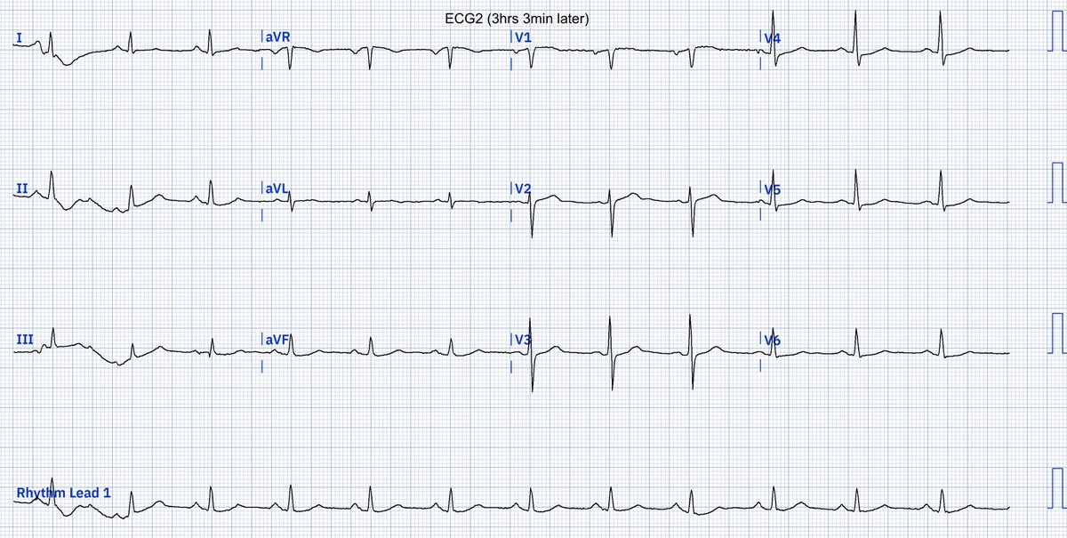 EcgOxford's tweet image. Acute CP (H/O 6-month exertional CP)
Dx?
@akneton @yolyabreuh @UlhasDr @DidlakeDW @ecgrhythms @IhabFathiSulima @DrPharmDMDTh @Vadeboncoeur_Al @smithECGBlog @EM_RESUS
@estudiomedicina @OrlandoRPN @fxgodzeuss #EPeeps #FOAMcc @ResusMed @TrRja @NaokiThukishima @ecgandrhythmRoe