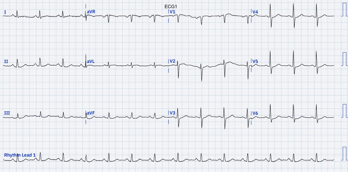 EcgOxford's tweet image. Acute CP (H/O 6-month exertional CP)
Dx?
@akneton @yolyabreuh @UlhasDr @DidlakeDW @ecgrhythms @IhabFathiSulima @DrPharmDMDTh @Vadeboncoeur_Al @smithECGBlog @EM_RESUS
@estudiomedicina @OrlandoRPN @fxgodzeuss #EPeeps #FOAMcc @ResusMed @TrRja @NaokiThukishima @ecgandrhythmRoe