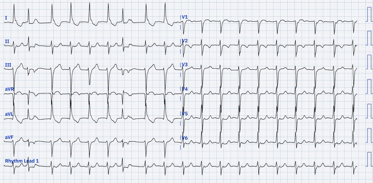 EcgOxford's tweet image. Rhythm?
@akneton @yolyabreuh @UlhasDr @DidlakeDW @ecgrhythms @IhabFathiSulima @DrPharmDMDTh @Vadeboncoeur_Al @smithECGBlog @EM_RESUS
@estudiomedicina @OrlandoRPN @fxgodzeuss #EPeeps #FOAMcc @ResusMed @TrRja @NaokiThukishima @ecgandrhythmRoe