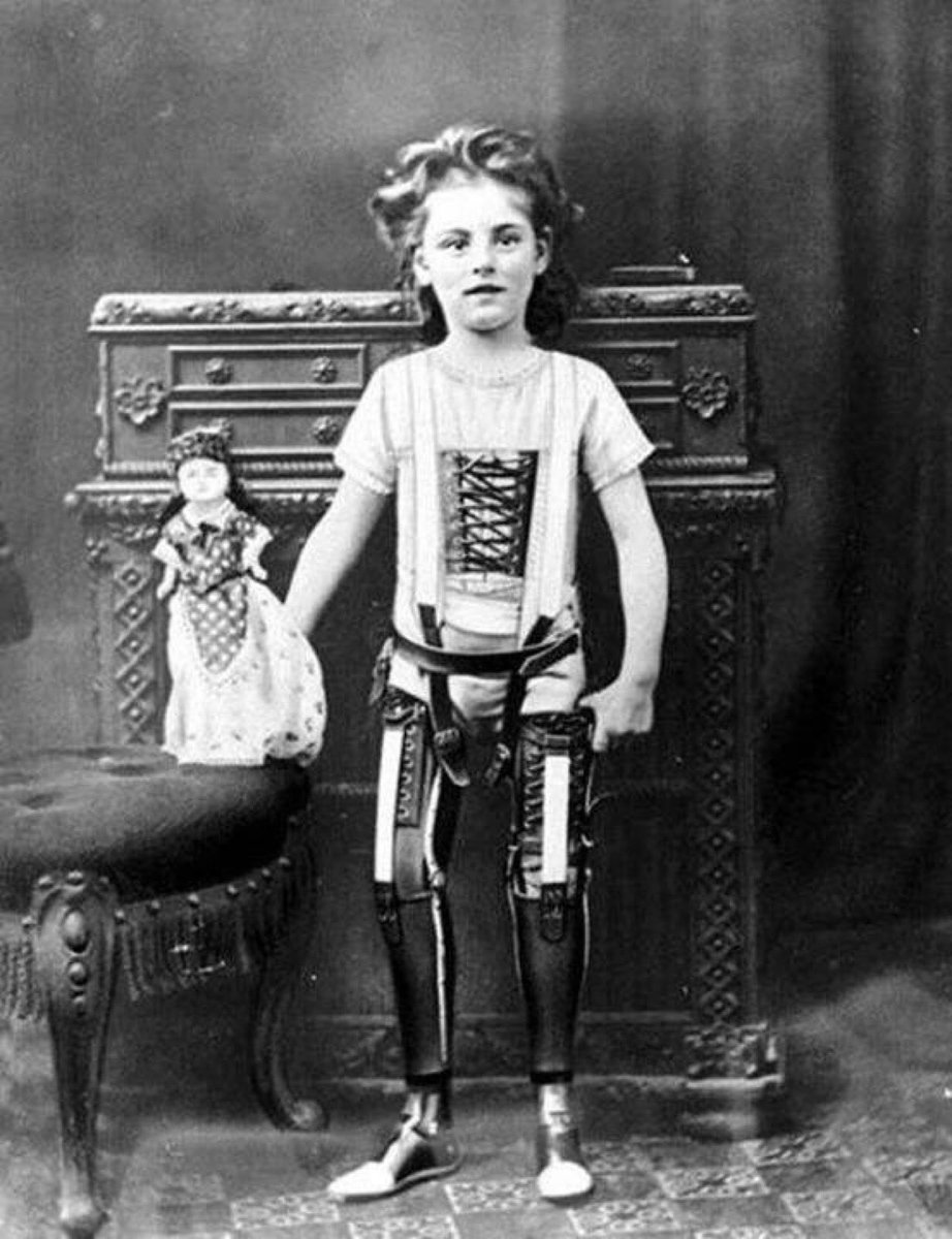 PastMedHistory's tweet image. A girl with artificial legs circa. 1880 #prosthesis #histmed #historyofmedicine #pastmedicalhistory