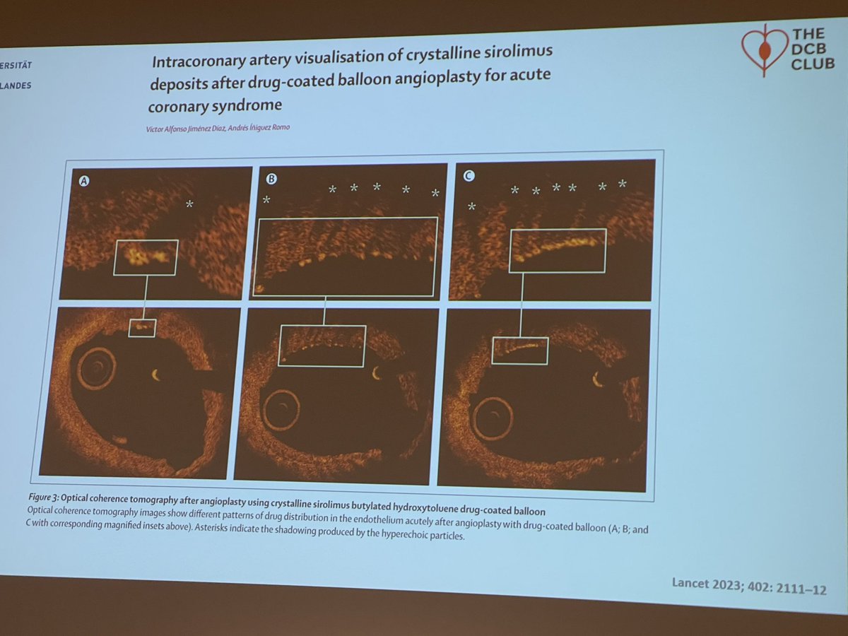 stefan_harb's tweet photo. @KambisMashayek1 @azeemlatib Bruno Scheller #sirolimus vs #paclitaxel
#DCBClub 2025 https://t.co/t1AbFtorDE