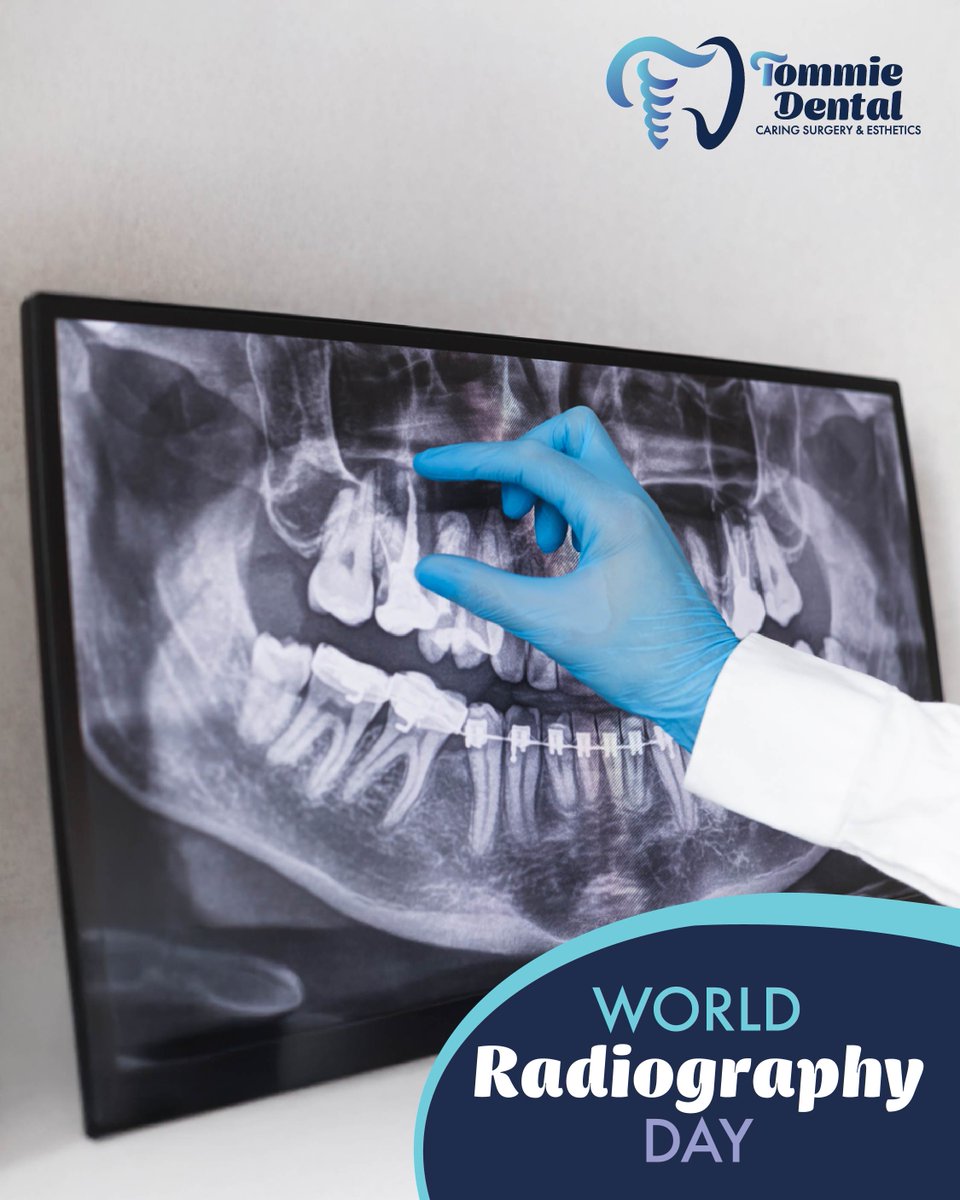 Did you know dental X-rays play a key role in detecting and preventing oral health problems? They help reveal hidden issues like cavities, bone loss, and infections. This World Radiography Day, we’re celebrating the technology that helps us protect and maintain healthy smiles.