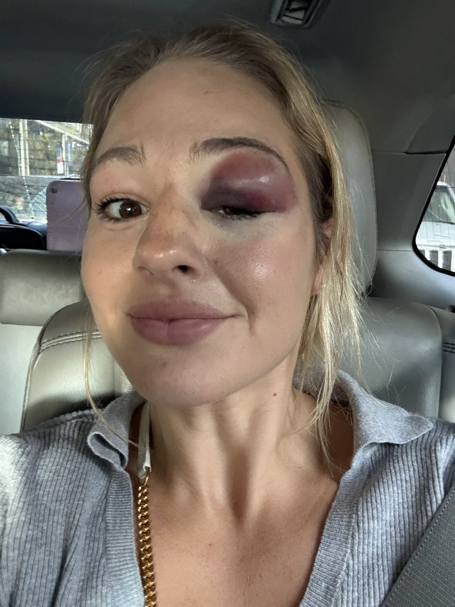 Rough tournament back for me and an even rougher face. 

Acquired my first real black eye on the positive side 🤣