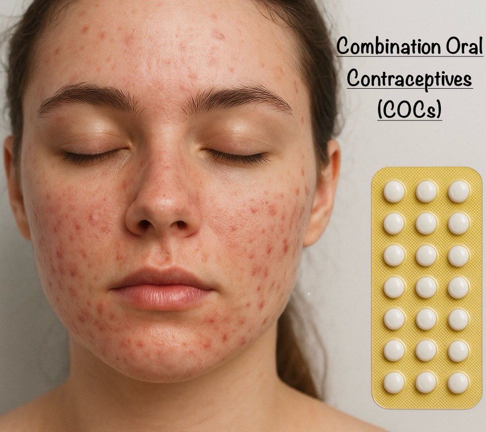 FosterDrugInfo's tweet photo. 💢#Acne_Vulgaris Management: COCs

✅FDA Approved:
EE 20/30/35 +#Norethindrone 1mg
EE 35 +#Norgestimate 180/215/250mcg
EE 20 +#Drospirenone 3mg

❇️Others (Anti-Androgens):
EE 30 + #Drospirenone 3mg
EE 30 + #Dienogest 2mg
EE 30 + #Chlormadinone 2mg
EE 35 + #Cyproterone_Acetate 2mg https://t.co/8fvseYJKxf