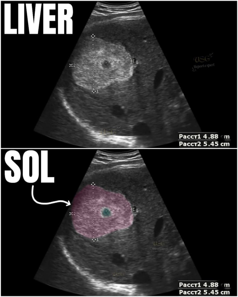 EchoTech_4's tweet image. 🧐 “Can you identify which liver segment 😳 this SOL is located in?”

#fblifestyle #ultrasound #ultrasoundtech #ultrasoundlife #ultrasoundtechnologist #LiverDisease #liverhealth #liverdetox