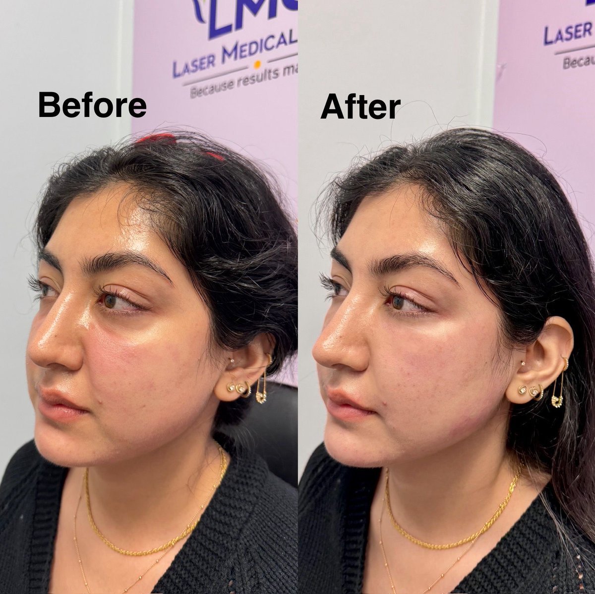 lmclaser's tweet photo. Natural lift. Real results. 🌿
After just one NaturaGel PRP Filler session, skin tone looks smoother, puffiness reduced, and texture refined …and all from your own plasma.
#nutragelprpfiller #prpfiller #lmc #beforeafter #toronto https://t.co/8rYxzwuG2q