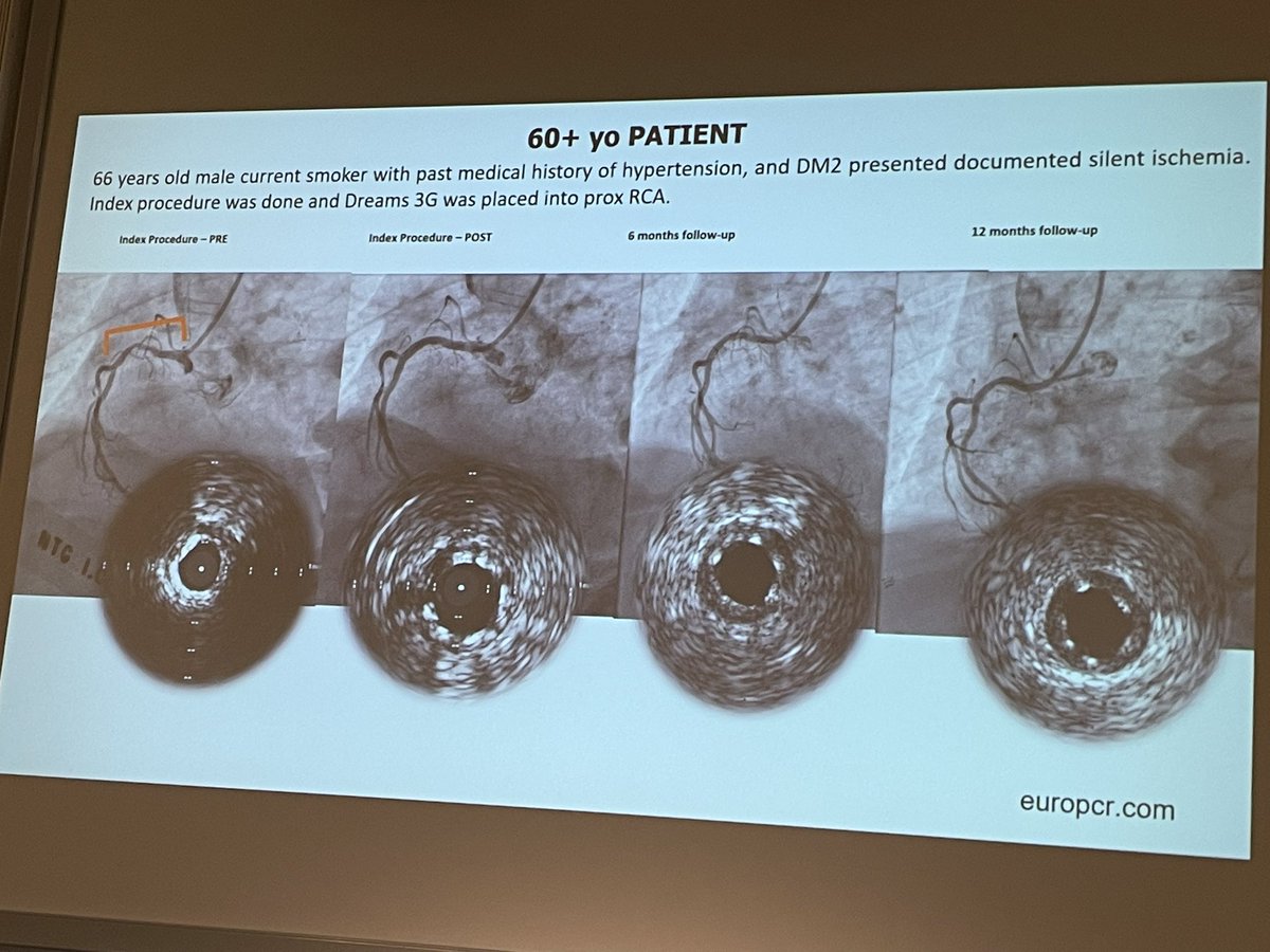 stefan_harb's tweet photo. @KambisMashayek1 @azeemlatib Hector M. Garcia Garcia illustrating different appearance of “aluminum tattoo” leftover of Dreams Mg Al #bioresorbablescaffold on #IVUS and #OCT

Will #BRS be the future? Or the device vor bailout stenting in #DCBstrategy?

#DCBClub #DCBClub2025 Berlin https://t.co/VyUqEu5TTl