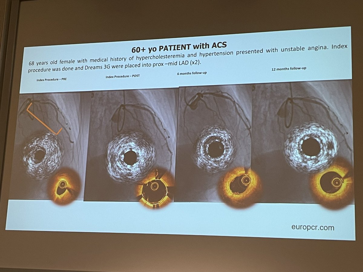 stefan_harb's tweet photo. @KambisMashayek1 @azeemlatib Hector M. Garcia Garcia illustrating different appearance of “aluminum tattoo” leftover of Dreams Mg Al #bioresorbablescaffold on #IVUS and #OCT

Will #BRS be the future? Or the device vor bailout stenting in #DCBstrategy?

#DCBClub #DCBClub2025 Berlin https://t.co/VyUqEu5TTl