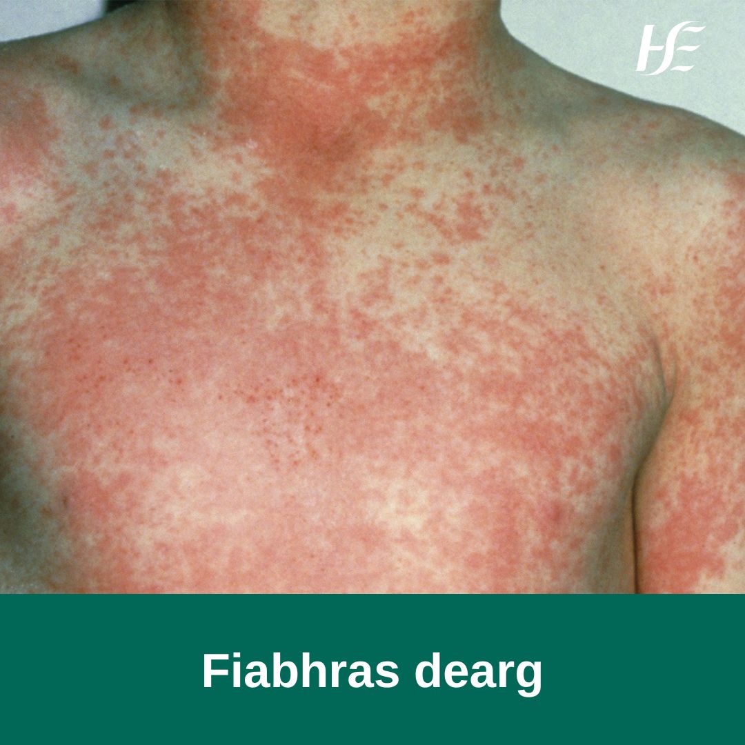 Ionfhabhtú tógálach is ea an fiabhras dearg a bhaineann do leanaí óga den chuid is mó. Is féidir leis a bheith ar dhuine ar feadh seachtaine ach is furasta é a chóireáil le antaibheathaigh. Tá an fiabhras dearg iontach tógálach agus scaiptear é ar dhaoine eile go han-éasca.