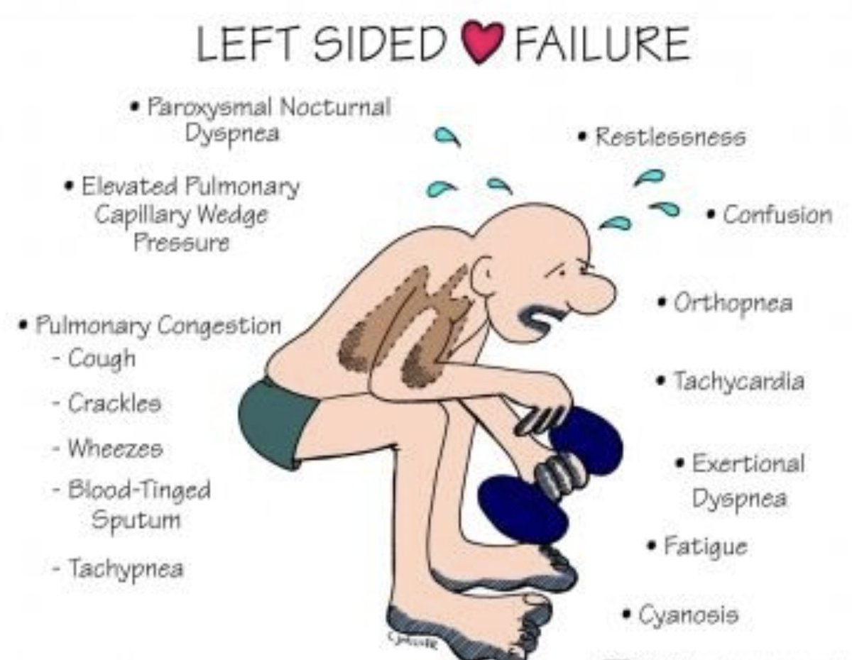 USMLEStepStudy's tweet image. Left (ventricular)-sided heart failure is when main pump fails
🫀  Pump: Left Ventricle
❌  Failure: Can&apos;t push blood forward to your body
🌊  Backup: Fluid floods back into the lungs
🤧  s/s: Drowning feeling (SOB, crackles, fatigue)
#CardioX #HeartHealth #MedEd #MedEdTutor