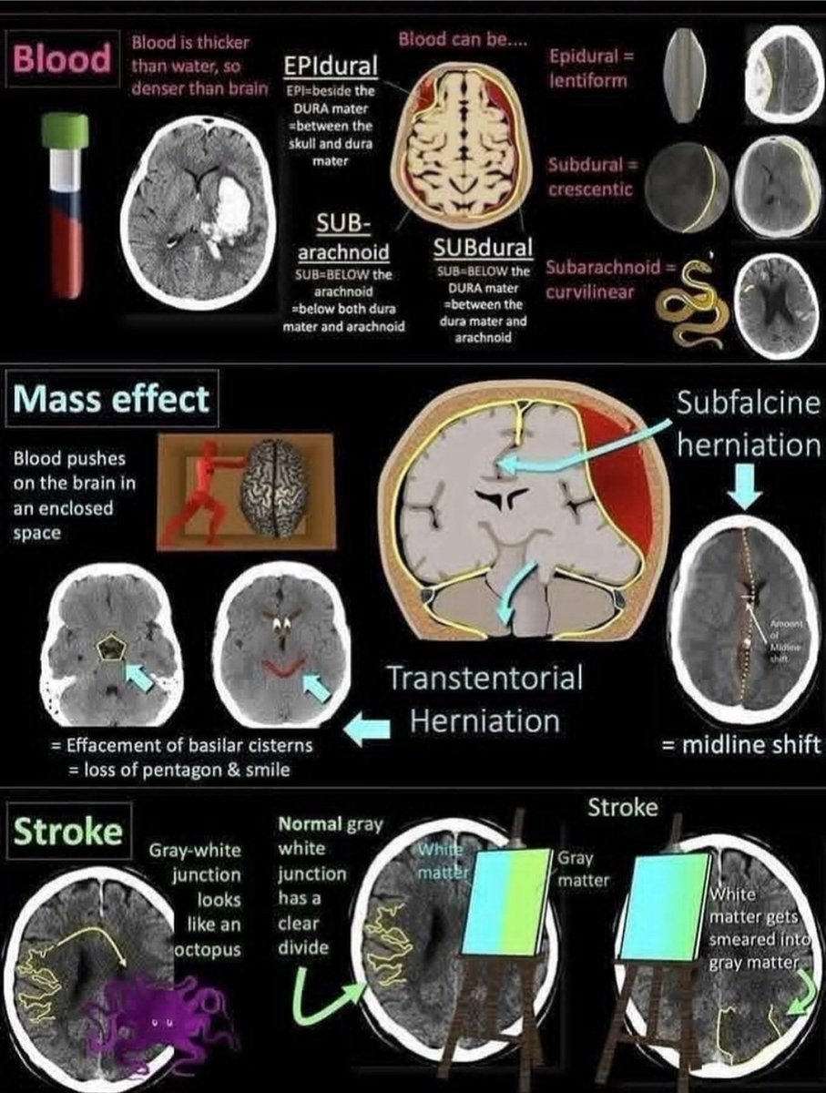 A guide to interpreting head CT scans for various acute neurological conditions, including intracranial hemorrhages, mass effect, herniations, and stroke. 

instagram.com/p/DQrn7EEgFP7/…