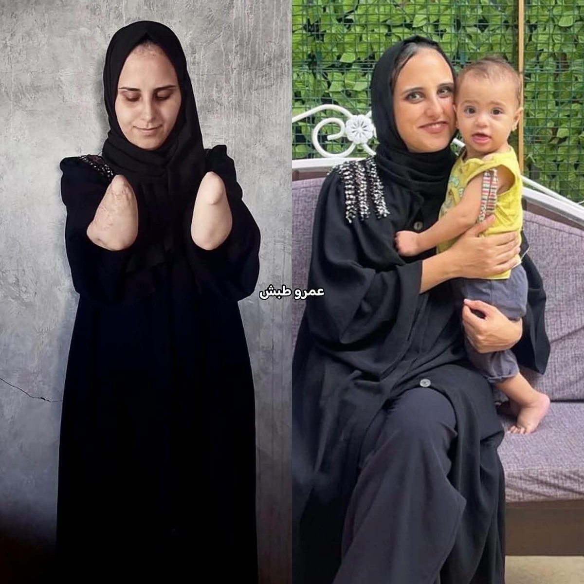 هل ما زلتم تتذكرون نبال الهسي؟ الأم التي لا تستطيع حتى الآن احتضان طفلتها ريتا 💔

نبال (25 عامًا) فقدت ذراعيها وهي تحمي طفلتها خلال قصف إسرائيلي دمر حياتها، تعرضت لإصابات بالغة أدت إلى بتر كلتا الذراعين من أسفل المرفقين، وتلف خطير في الكبد والساق، وحروق عميقة تركت ندوبًا مؤلمة