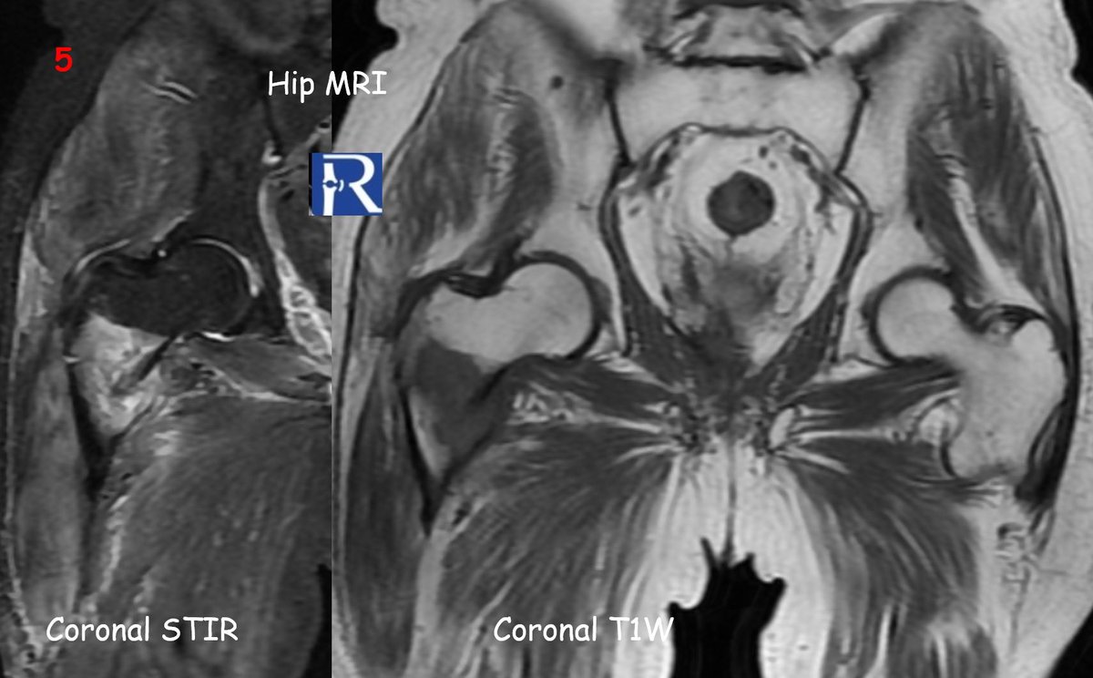radiologybmj's tweet photo. A 75-year-old male with known prostate cancer presented withright hip pain and an antalgic gait. He denied any trauma. #Radiology #MSKradiology #BoneTumor #HipMRI #Metastasis #LesserTrochanter #PathologicFracture #ProstateCancer #RadiologyEducation #CaseOfTheWeek #orthotwitter #radtwitter #Medicine #MedTwitter
