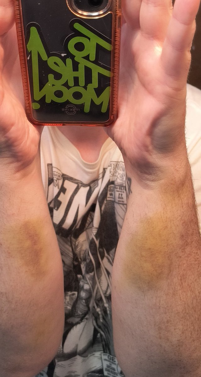 Never walk down wet sketchy steps in the dark. Shit Sucks!