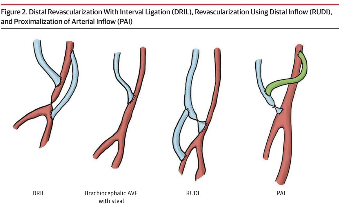 El síndrome de robo se desarrolla hasta en 20% de los pacientes que se hemodilizan mediante una fístula arteriovenosa, el ~9% requiere tratamiento quirúrgico para su manejo; en la imagen algunas de las estrategias quirúrgicas

 JAMA Surgery 2025
10.1001/jamasurg.2025.4701