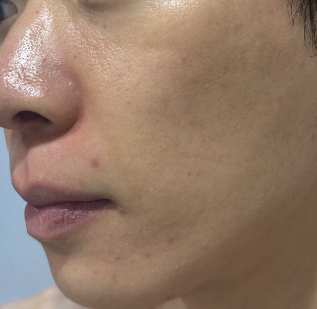 アクネバスター tweet media