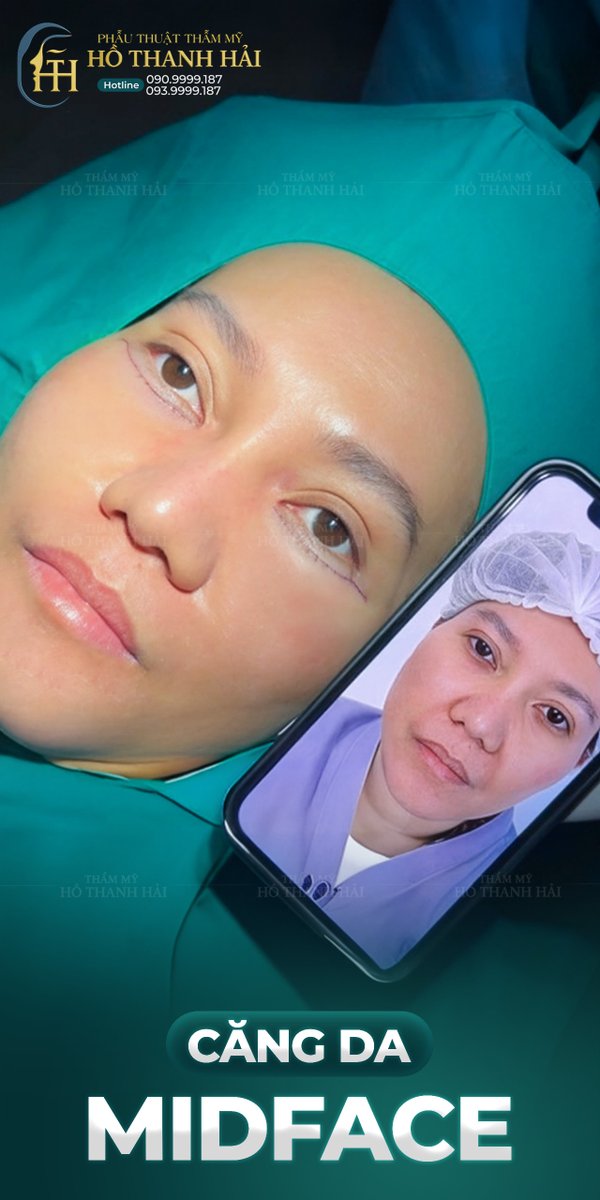 drhothanhhai's tweet image. #MIDFACE – TRẺ HƠN 10 TUỔI CHỈ SAU 90 PHÚT ✨

VÙNG TRUNG TÂM KHUÔN MẶT (MIDFACE) LÀ “ĐIỂM VÀNG” QUYẾT ĐỊNH NÉT TƯƠI TRẺ VÀ THẦN THÁI. KHI VÙNG NÀY CHẢY XỆ – KHUÔN MẶT LẬP TỨC MẤT ĐI SỰ SĂN CHẮC, RẠNG RỠ.

TẠI THẨM MỸ BÁC SĨ HỒ THANH HẢI, KỸ THUẬT