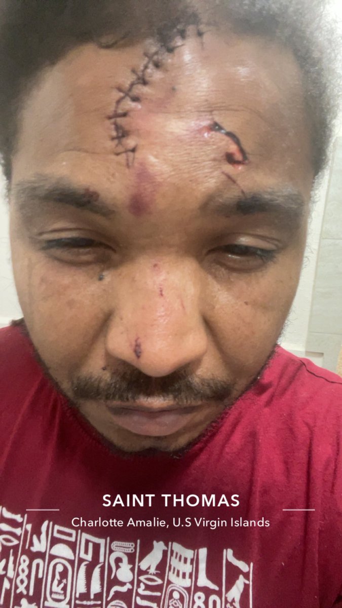 RandyNotNice's tweet image. Hit by a van today