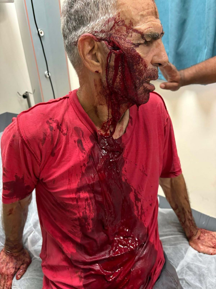 RamAbdu's tweet image. “They opened his head with a 4 cm cut and broke his cheekbone. He will be fine. *None of the attackers, of course, have been arrested.*

14 others were injured in this incident – Israeli activists, Palestinians, paramedics who came to help with the rescue, and journalists.“