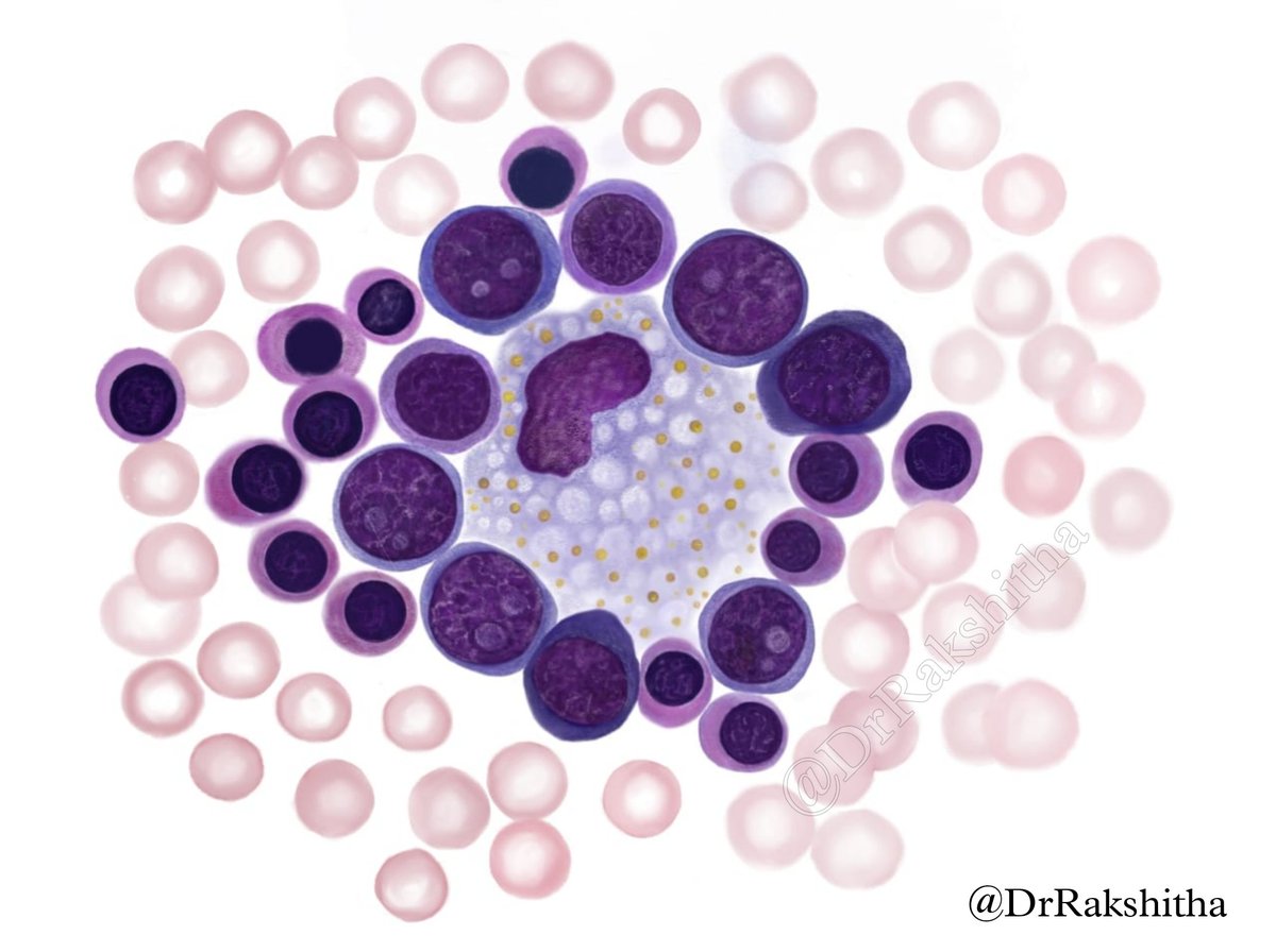 Illustration:H8
Bone Marrow Aspiration Smear
Erythroid Island 
The heart of erythropoiesis - an ecosystem within the bone marrow,where red cell precursors gather around their nurturing macrophage.
#pathology #hematology #pathart #PathTwitter #erythroidisland #illustration