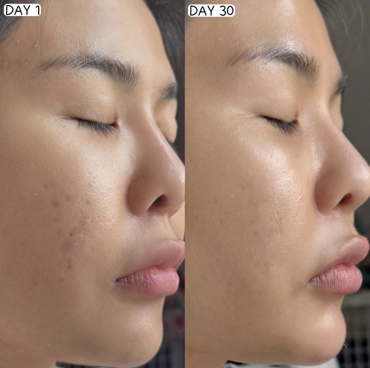 ก่อนหน้านี้สิวขึ้นวันเว้นวันและทิ้งรอยสิวไว้หนักมากกกก ลองใช้มาหมดสรุปมาจบที่คู่ Eucerin Pro Acne Solution อย่างที่เค้าแนะนำกันจริงๆ ตัวเจลโฟมช่วยทำความสะอาดผิวได้หมดจด ลดหน้ามัน ผิวสะอาดแต่ไม่แห้งตึง ใช้คู่กับเซรั่มที่มีส่วนผสมจึ้งๆอย่าง Salicylic acid ที่ช่วยลดสิว