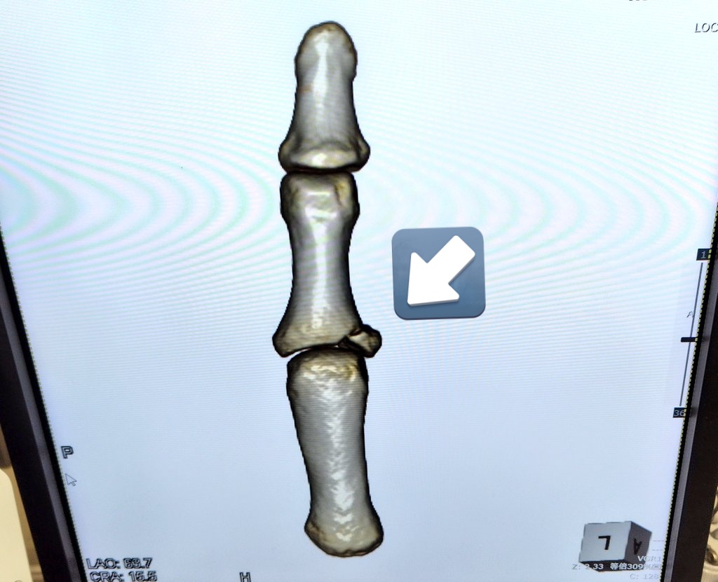code00888's tweet image. スポーツやってると仕方ないよなー
娘が親指の付け根を骨折😢
場所が悪くて明日急遽手術だよ、月末に大きい最後の大会控えてたのに残念無念……
手術も血管とか神経に影響出るかもしれんと言ってたから無事に終わるよう祈ってる