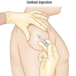 TrackYourHeart's tweet image. The recommended concentration of adrenaline for intramuscular injection in anaphylaxis is:
a) 1:1,000 (1 mg/ml)
b) 1:10,000 (0.1 mg/ml)
c) 1:100 (10 mg/ml)
d) 1:100,000 (0.01 mg/ml)