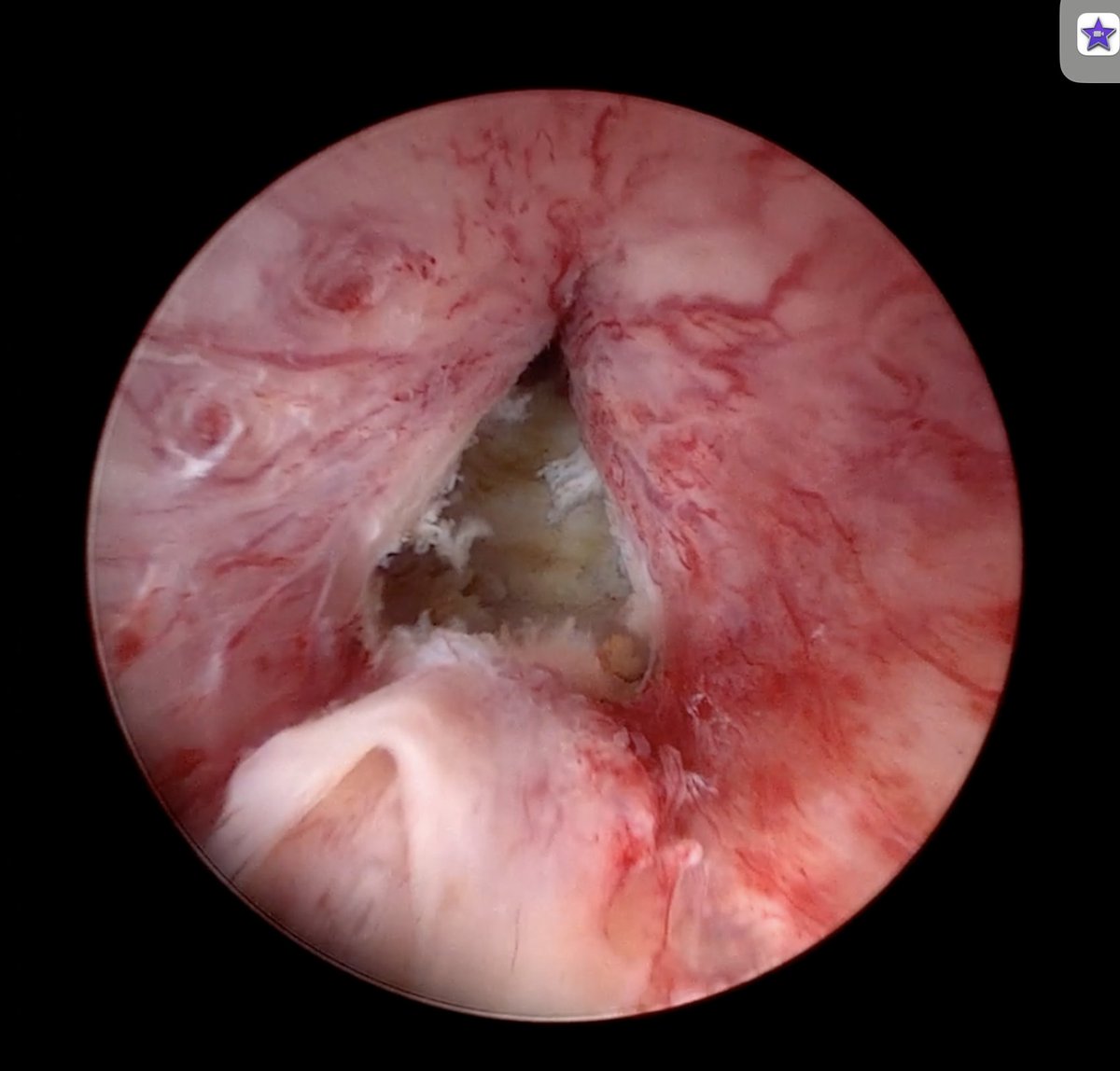 trwherrmann's tweet image. Looking forward to this  webinar of #ESSM @essm_tweets 11th November, 2025 &quot;The impact of surgical treatment of BPO and its impact on sexual function&quot; in #EEP #AEEP and what is possible. Thanks for the invite @dr_romero_otero @OsmonovDr #HoLEP
Link lnkd.in/dhcTf5gPÄ