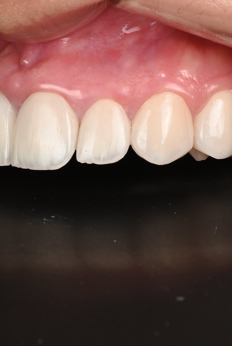 صحة اللثه قبل صحة الأسنان 😁👌
.
مراجعه من الباحه كانت التركيبات مسببه روائح والتهابات شديده في اللثه، بعد ازالة التركيبات القديمه تم عمل اعادة عصب للأربع الأسنان الاماميه عن طريق الدكتور عمر الزهراني استشاري علاج العصب
.
بعد كذا تم عمل اعادة تحديد التحضير ( relocate the