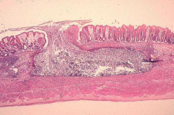 DrAkhilX's tweet image. A patient with dysentery and liver abscess.

Colon biopsy and abscess aspirate are shown.

What is this❓️